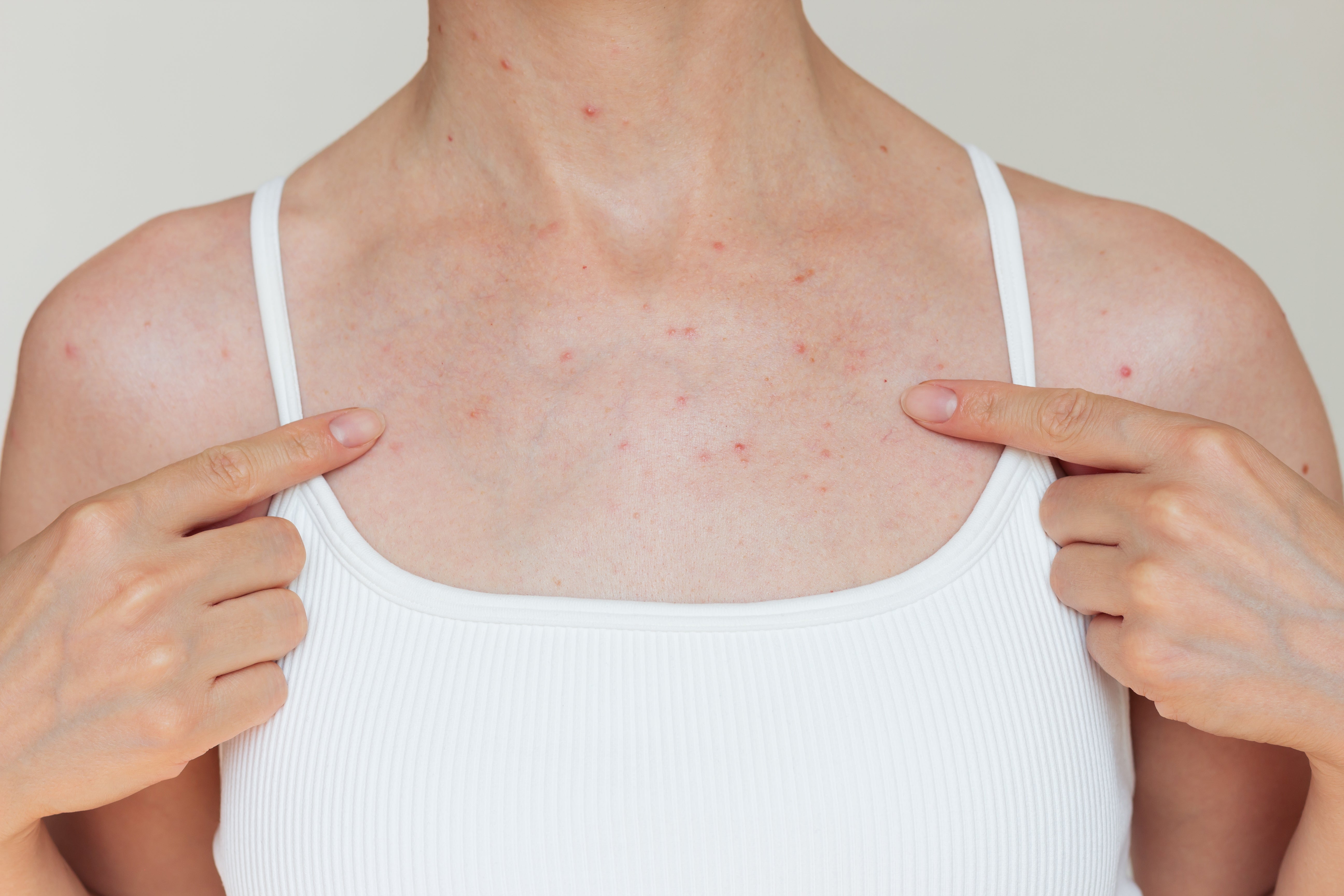 Understanding hormonal acne