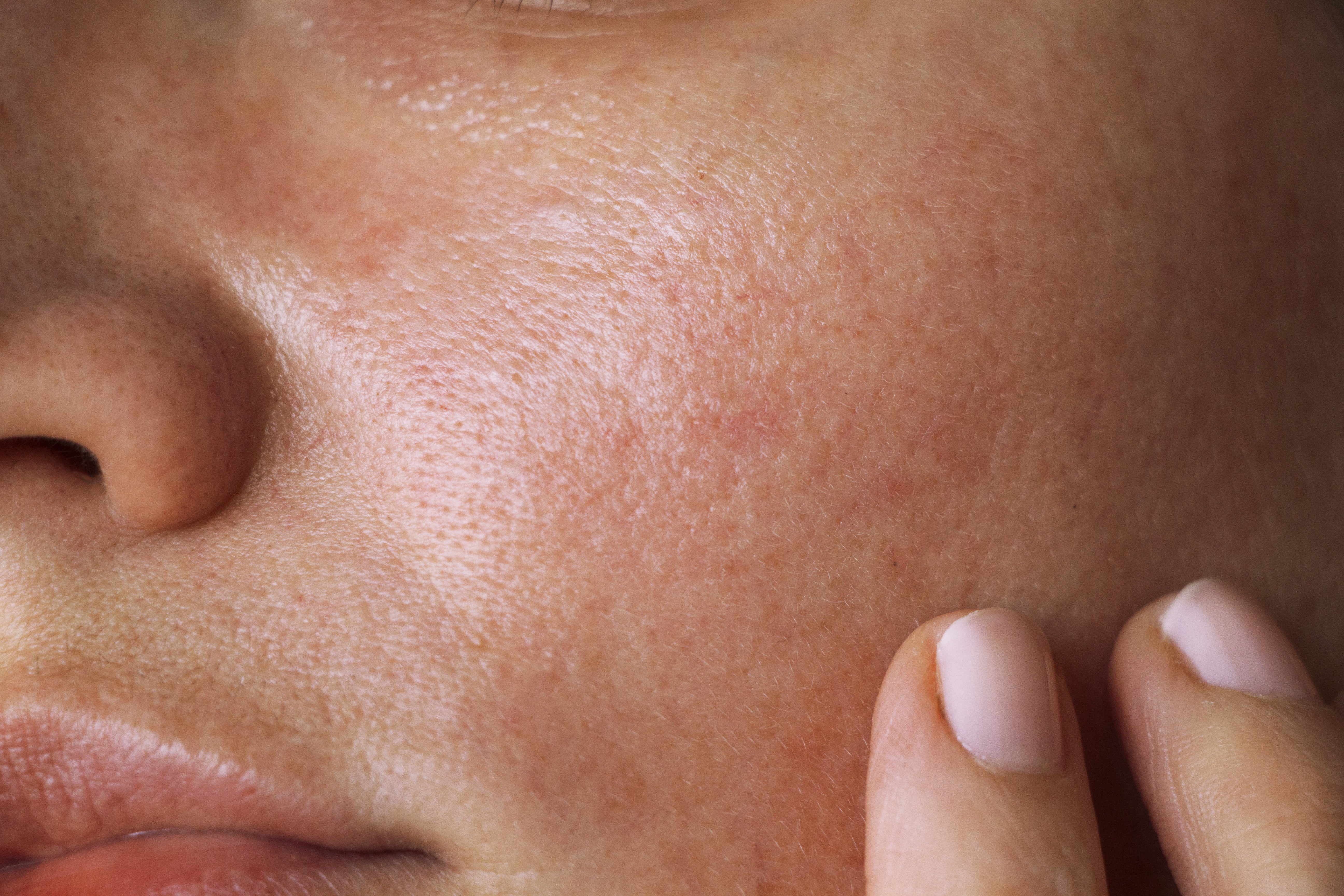 How To Really Cure Acne