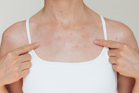 Understanding hormonal acne