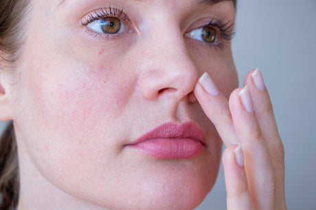 Understanding Rosacea and How to Treat it