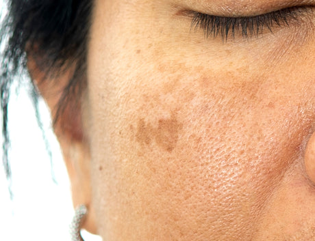 Sun pigmentation treatments