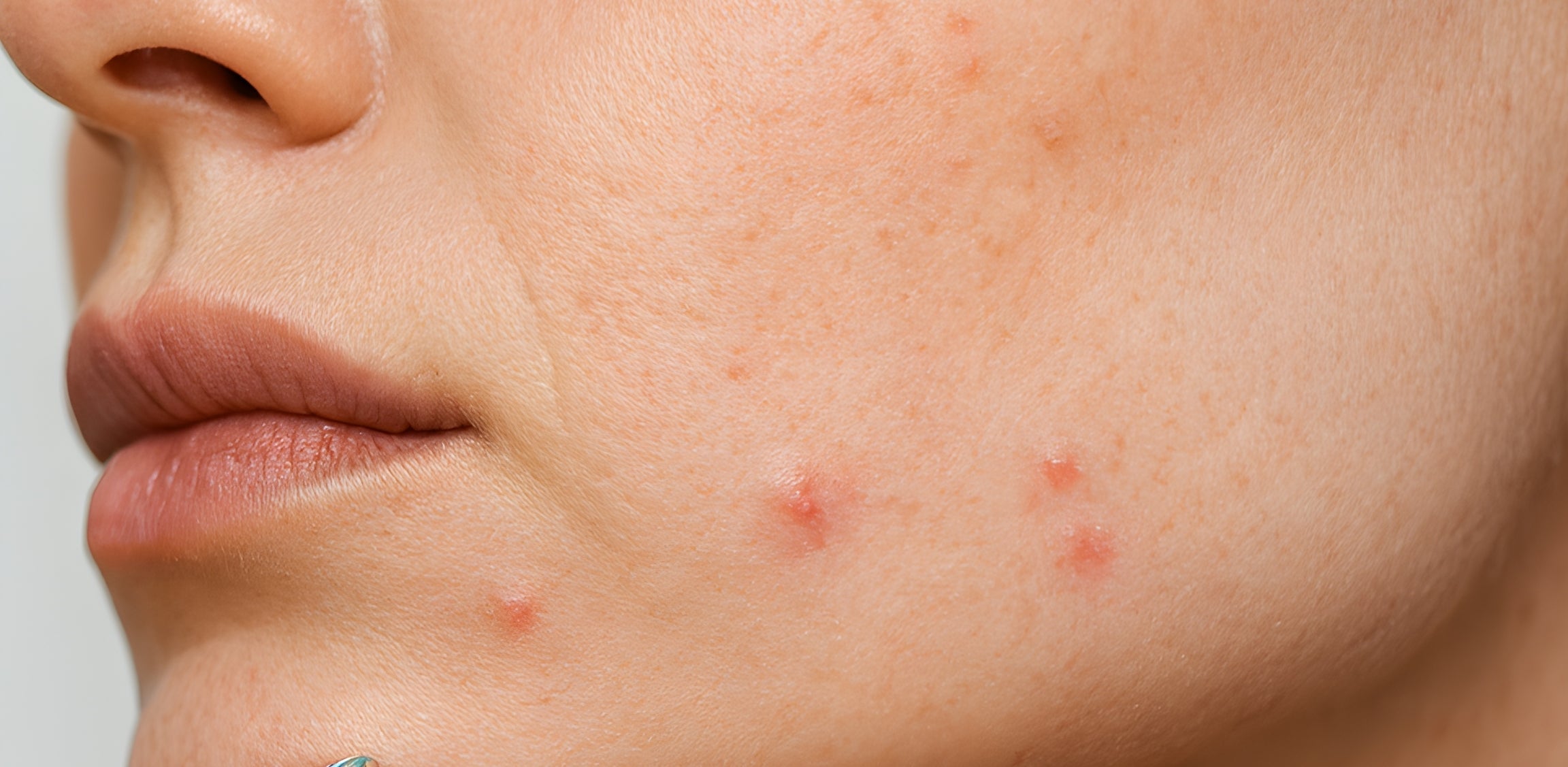 Understanding hormonal acne