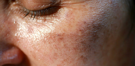 How to really get rid of sun pigmentation!