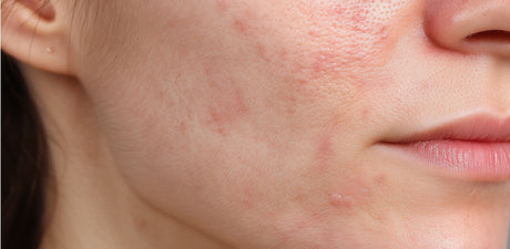 How To Really Cure Acne & Congestion